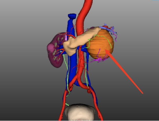 哈醫(yī)大二院泌尿外科運(yùn)用達(dá)芬奇手術(shù)機(jī)器人 精準(zhǔn)切除腎上腺巨大腫瘤